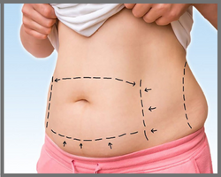 PG Diploma in Obesity Management
